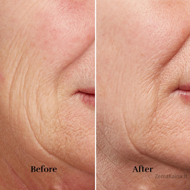 Silkn FaceTite Revive FTC1PE1001 4